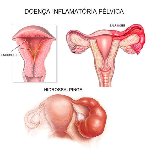 Endometrite: como é feito o tratamento