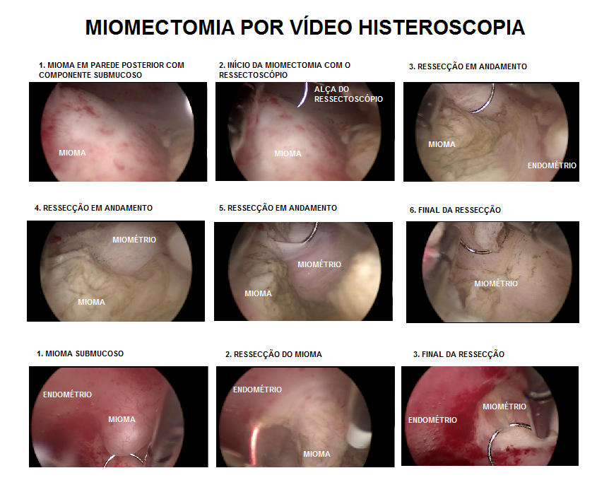 Doenças que o exame de videohisteroscopia pode identificar - Scope  Ginecologia